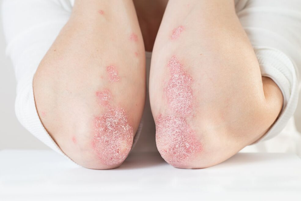 Un esempio di lesioni cutanee sui gomiti dovute alla psoriasi