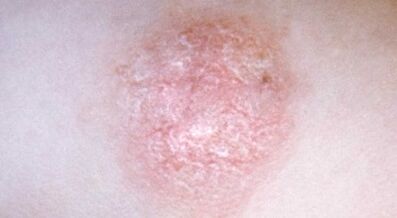 Come riconoscere precocemente la psoriasi