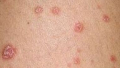Foto della psoriasi nelle fasi iniziali