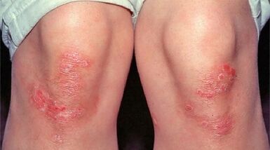 Principali manifestazioni della psoriasi