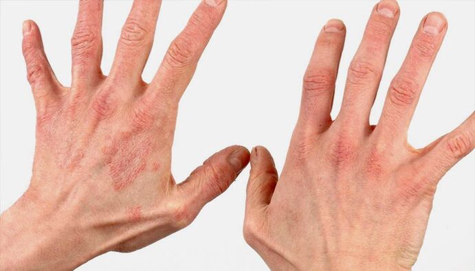 Metodi di trattamento della psoriasi con rimedi popolari