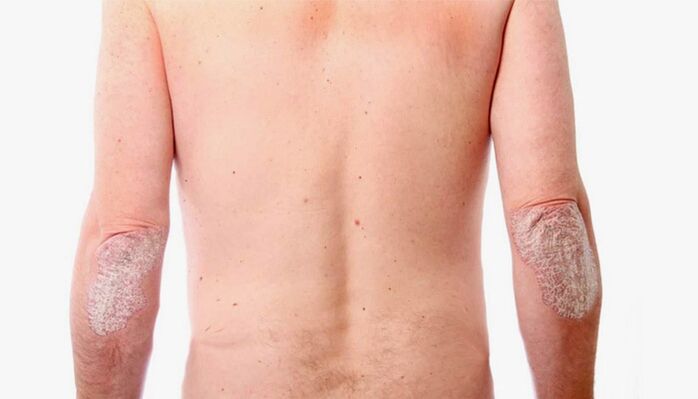Rimedi popolari per il trattamento della psoriasi