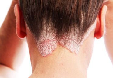 Psoriasi sulla testa