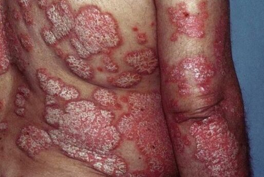 psoriasi