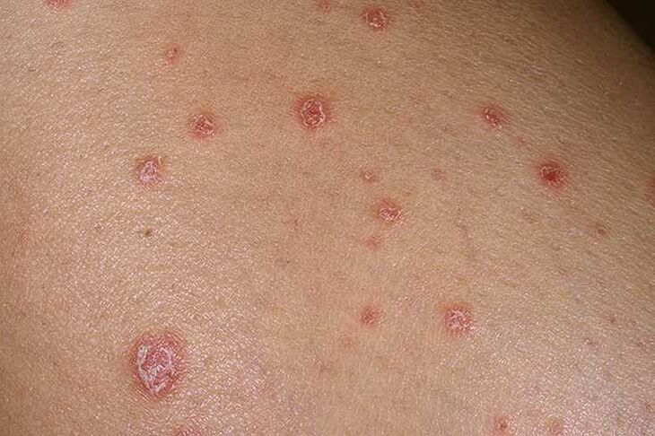Le cause della psoriasi