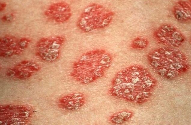 Psoriasi papules