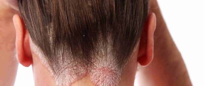 Psoriasi della testa