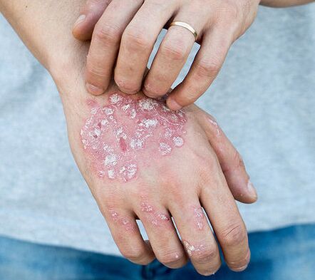 Psoriasi sul braccio