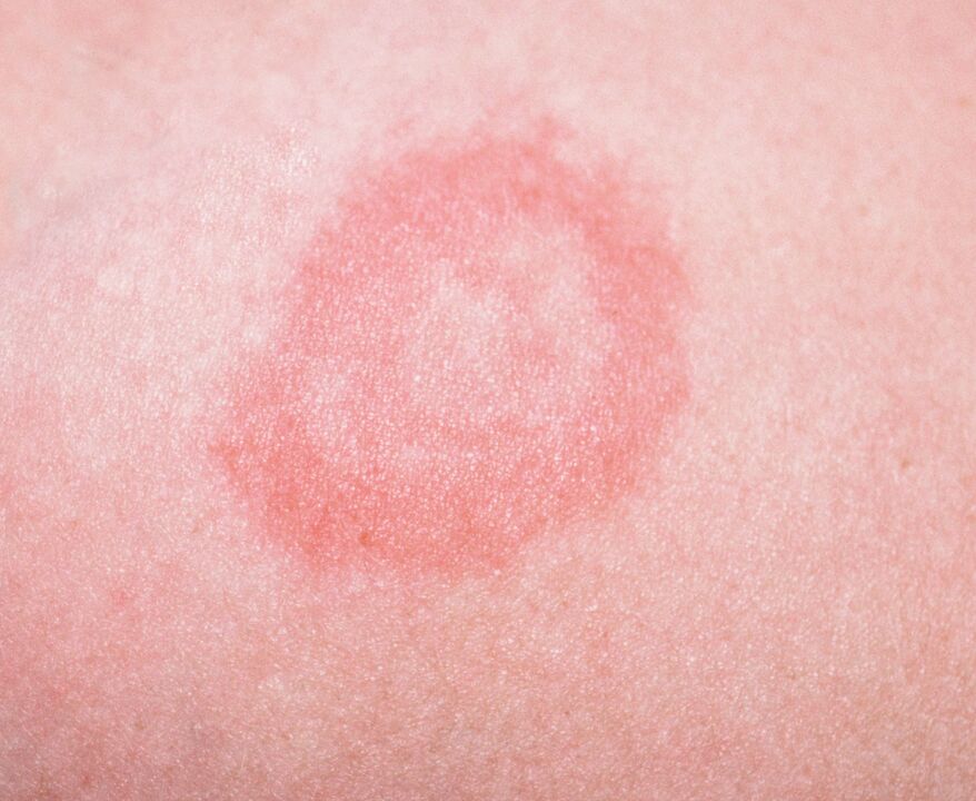 La psoriasi è