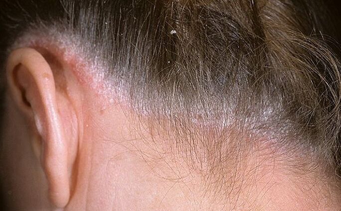 Psoriasi tra i capelli