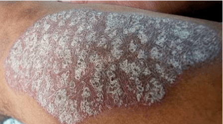 Patogenesi della psoriasi