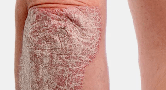 psoriasi