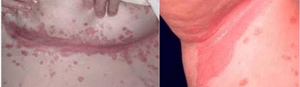 Forma atipica della psoriasi