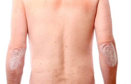 Sintomi generali della psoriasi