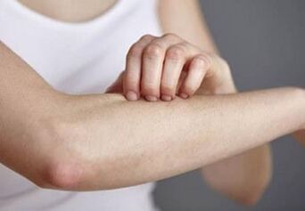 Psoriasi sulla mano