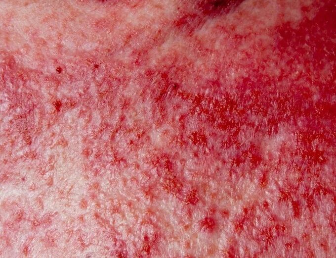 Forma avanzata di psoriasi