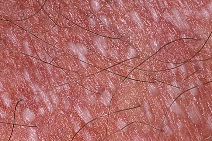Psoriasi pustolosa