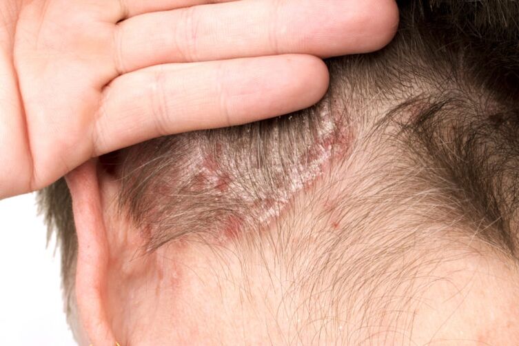 Peggioramento della psoriasi sulla testa