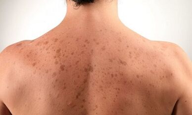 Ragioni per lo sviluppo della psoriasi