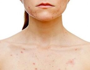In quale parte del corpo si manifesta la psoriasi