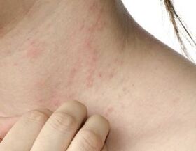 Principali sintomi della psoriasi