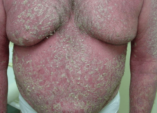 Eritroderma psoriasico sul corpo