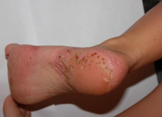 Psoriasi palmoplantare