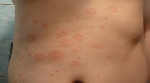 Psoriasi sul corpo