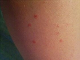 Psoriasi sulla pelle