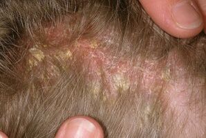 Psoriasi sulla testa